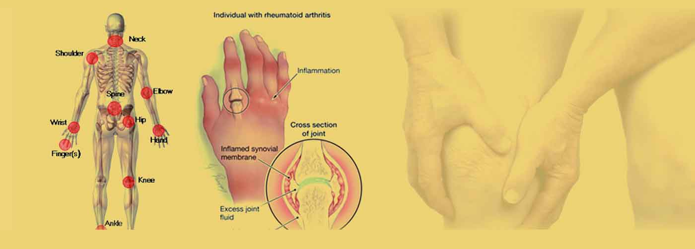 - Rheumatology treatment in pune